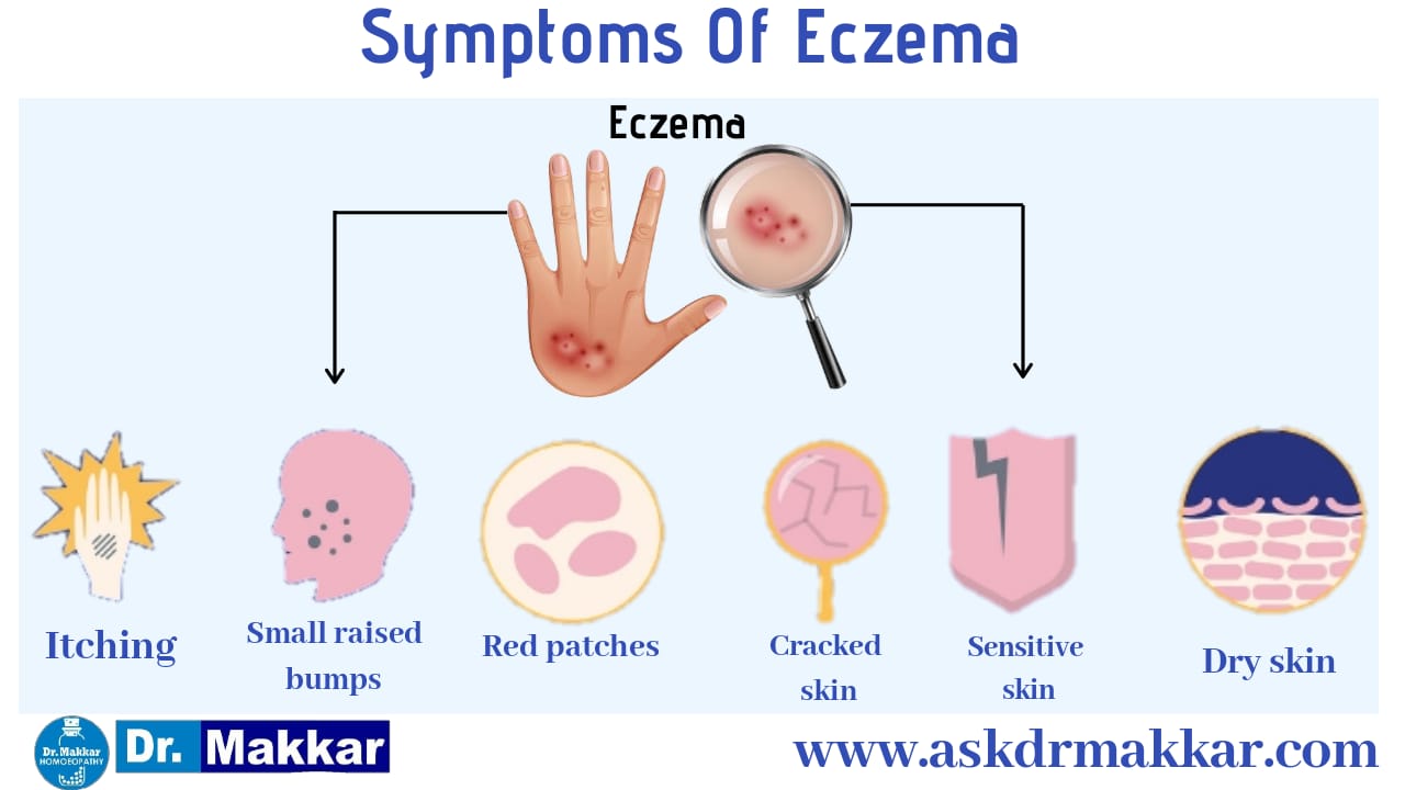 Symptoms of Eczema